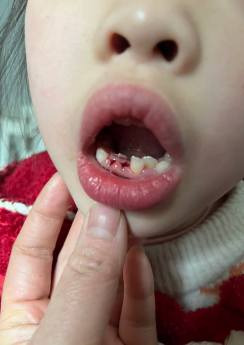 医生误判将女孩恒牙当乳牙拔掉 科普：恒牙和乳牙区别